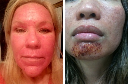 Lehetséges szövődmények után kémiai, lézer és más típusú peeling (szövődmények) Lehetséges szövődmények után kémiai, lézer és más típusú hámlasztás