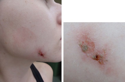 Lehetséges szövődmények után kémiai, lézer és más típusú peeling (szövődmények) Lehetséges szövődmények után kémiai, lézer és más típusú hámlasztás