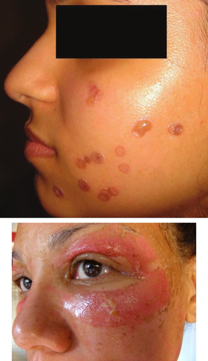 Lehetséges szövődmények után kémiai, lézer és más típusú peeling (kémiai) Lehetséges szövődmények után kémiai, lézer és más típusú hámlasztás