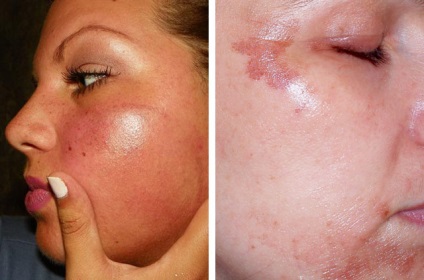 Lehetséges szövődmények után kémiai, lézer és más típusú peeling (kémiai) Lehetséges szövődmények után kémiai, lézer és más típusú hámlasztás