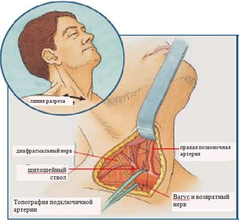 Sebészi kezelése ateroszklerotikus sérülések a subclavia - kardiológus - helyén