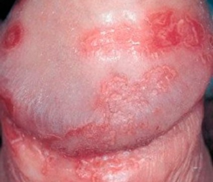 Хламідіоз - фото, як виглядають ознаки захворювання