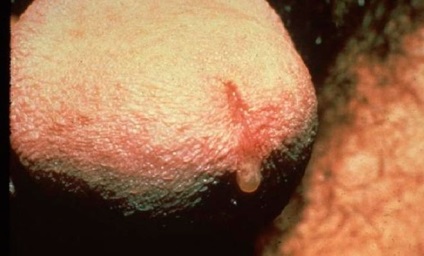 Chlamydia - a fotó néz ki, mint a betegség jelei