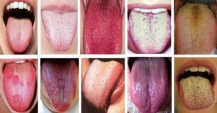 Tongue fehér, kellemetlen szagú a gyökér a nyelv, az íz, a lehetséges okok (nyelv) Tongue fehér, kellemetlen szag a gyökér a nyelv, az íz, a lehetséges okok