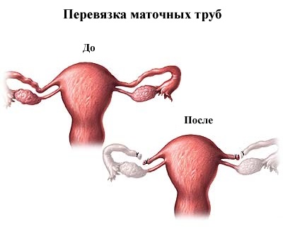 Nő és férfi sterilizálás