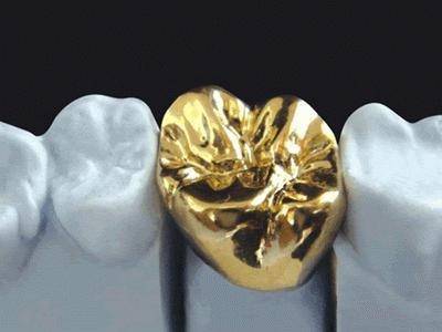 arany fogak