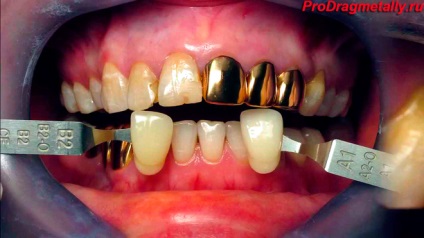 Fogászati ​​arany (fogászati), az ár grammonként, aranykoronát minta