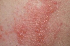 Allergiás zoster kezelésére