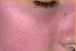 Алергія на ультрафіолет симптоми і лікування, алергія