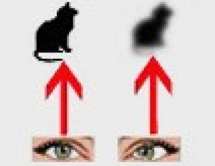 Amblyopia, vagy mi - lusta - szem (lusta) Amblyopia, vagy mi - lusta - szemek
