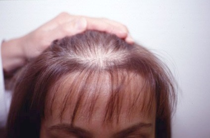 Androgén alopecia kezelt nőknél, áttekintésre, tünetek