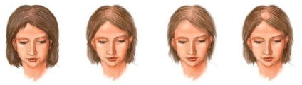 Androgén alopecia kezelt nőknél, áttekintésre, tünetek