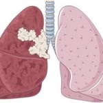 Azbesztózis Lung - tünetek, kezelés