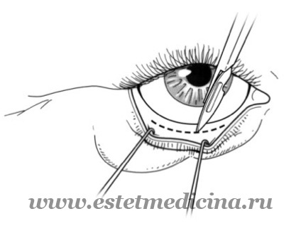 Blepharoplasty az alsó és a felső szemhéjakat Árak, visszajelzések, klinika, egy online folyóirat