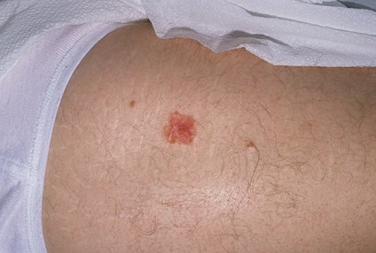 Bowen-kór egy fotót a daganat a férfiak, tünetei és kezelése