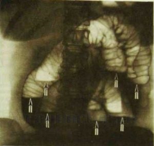 Tálak Klojber vagy X-ray a vékonybélben a folyosón a bárium