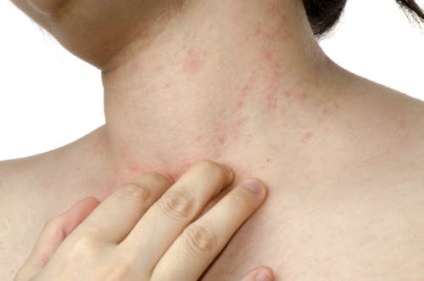 Dermatitis az okok nyak felnőttek és gyermekek kezelése