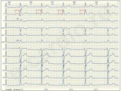 E-cardio tanulsága 2 (sinus-nesinusovy)