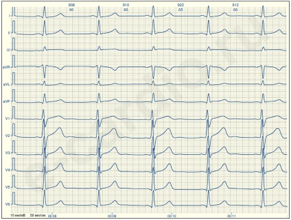 E-cardio tanulsága 2 (sinus-nesinusovy)