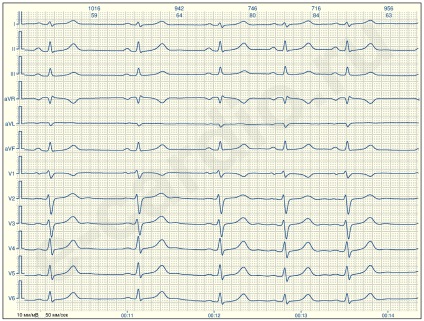 E-cardio tanulsága 2 (sinus-nesinusovy)