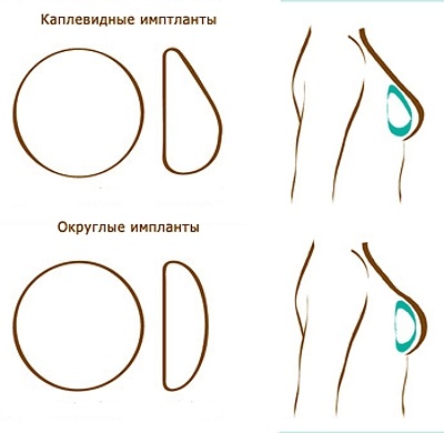 Az implantátumok után mammoplasty - akár a módosítani kívánt