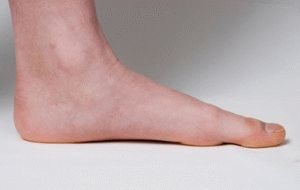 Csavarás lábujjak patológia és annak kezelése