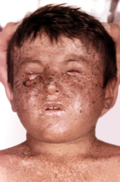 Xeroderma pigmentosum - azt (a kitett területeken a bőr) Xeroderma pigmentosum - ez