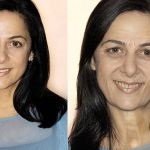 Lézeres bőr Biorevitalization előnyeit, hogy az eljárás (előtti és utáni képek)