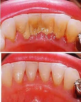 periodontitis kezelési költségek