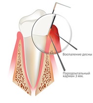 periodontitis kezelési költségek