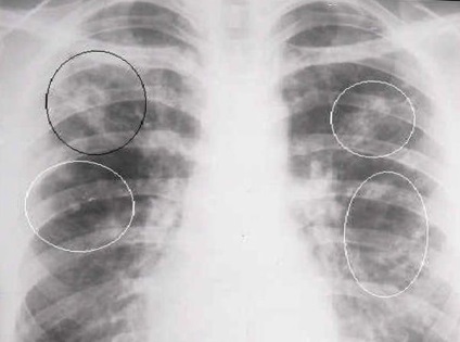 A tuberkulózis kezelése Budapesten