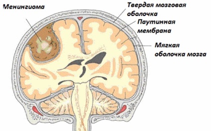 Менінгіома головного мозку лікування без операції і видалення менінгіоми, прогноз життя