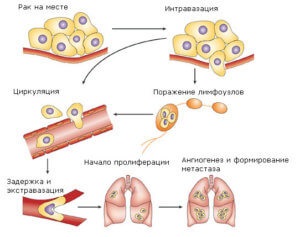 Metastasis gyomorrák - utak, különösen