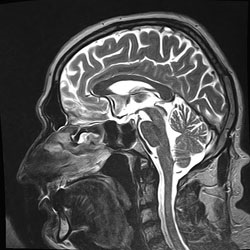 MRI sella - felfedje üres sella syndroma