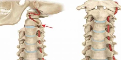 Neuralgia a nyaki gerinc tünetek és a kezelés