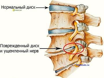 Diagnózis és kezelés osteochondrosis (diagnosztika) Diagnózis és kezelés osteochondrosis