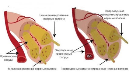 A perifériás neuropátia kezelik megnyilvánult betegség