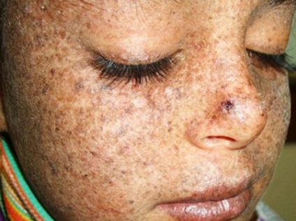 Xeroderma pigmentosum milyen okoz, tünetei és kezelése bőr xerosis gyermekeknél és felnőtteknél