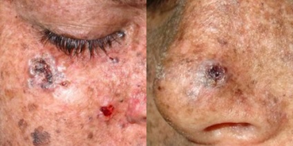 Xeroderma pigmentosum milyen okoz, tünetei és kezelése bőr xerosis gyermekeknél és felnőtteknél