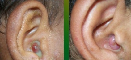Polip, a fül a tünetek a gyermekek, kezelési és eltávolítási működési módszer