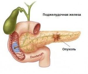hasnyálmirigy-rák kezelése cukorbetegséggel)