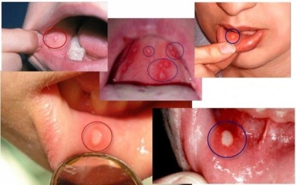 Stomatitis csecsemők okoz, és hogyan kell kezelni otthon