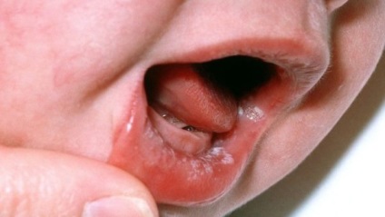 Stomatitis csecsemők okoz, és hogyan kell kezelni otthon