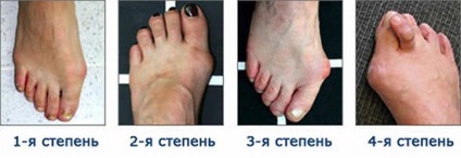 Valgus deformitás láb gyermekek és felnőttek módon diagnosztizálni és kezelni, a megelőzés