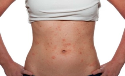 Bőrkiütés okoz, úgy néz ki allergiás bőrkiütés és kezelése