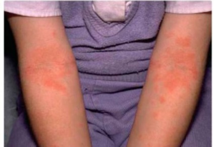 Bőrkiütés okoz, úgy néz ki allergiás bőrkiütés és kezelése