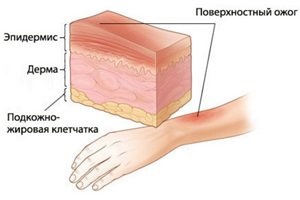 1, 2, 3 és 4, a mértéke égési, a jelek és tünetek