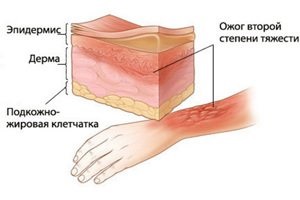 1, 2, 3 és 4, a mértéke égési, a jelek és tünetek