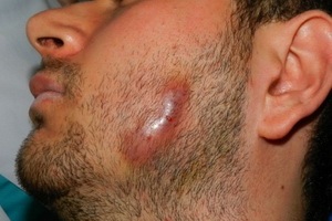 Actinomycosis személy fotó, okai és tünetei, hogyan kell kezelni aktinomikózis emberekben (humán kezelésére aktinomikózis) Actinomycosis személy fotó, okai és tünetei, hogyan kell kezelni aktinomikózis emberben