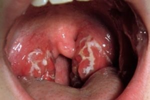 Angina (akut mandulagyulladás) - tünetek és a kezelés hatásainak